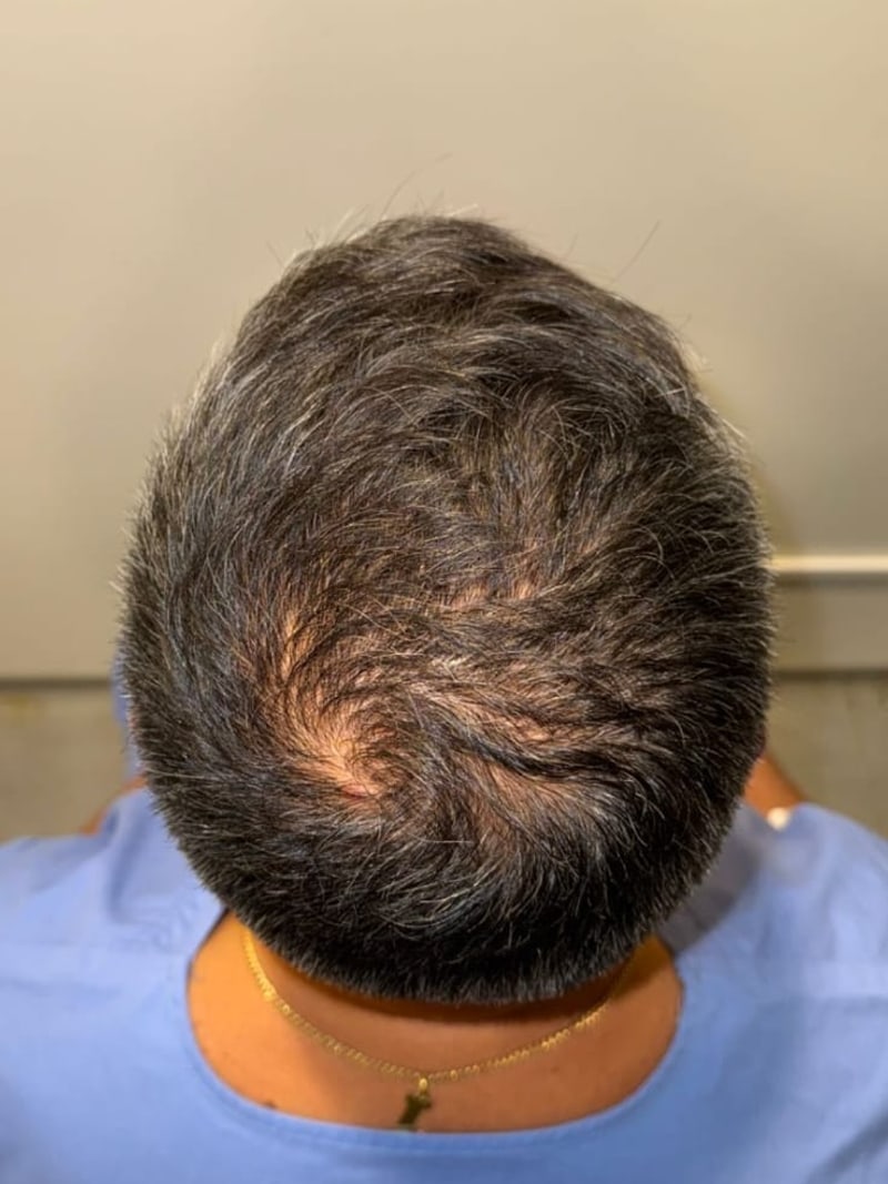 Antes — Tratamiento capilar con células madre, alopecia central