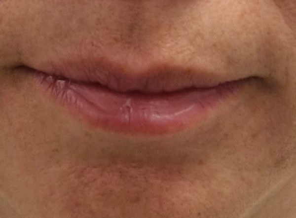 Antes — Relleno de labios con ácido hialurónico