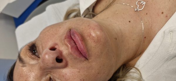 Después — Relleno de labios natural y armónico