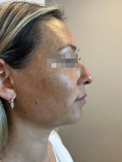 Antes — Armonización de perfil con ácido hialurónico