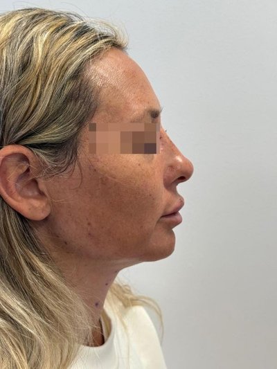Después — Armonización de perfil con ácido hialurónico