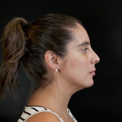 Antes — Rinomodelación y perfilado de labios
