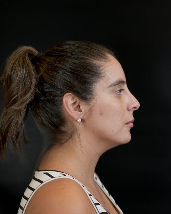 Antes — Rinomodelación y perfilado de labios con ácido hialurónico