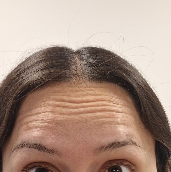 Antes toxina botulínica — líneas horizontales de frente marcadas