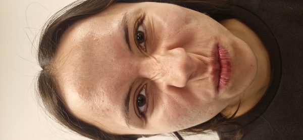 Antes — rostro completo con arrugas dinámicas