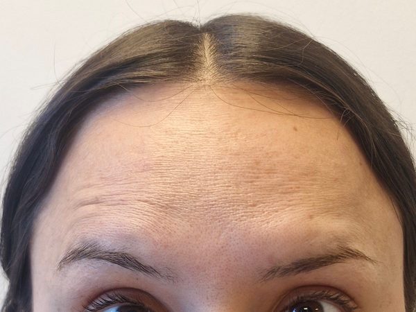 Después toxina botulínica — frente suavizada, expresión natural