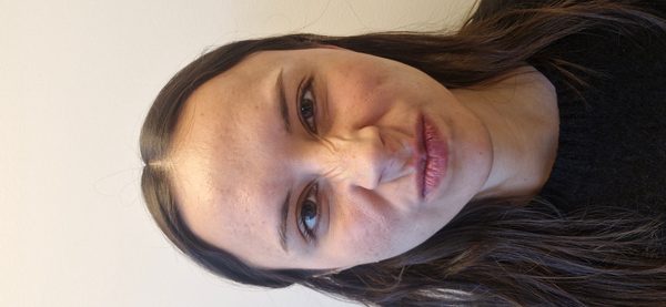 Después — entrecejo relajado y patas de gallo suavizadas