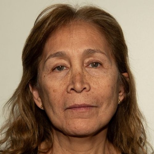 Antes — Bioestimuladores