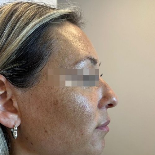 Antes — Perfil con Ácido Hialurónico