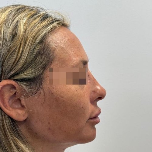 Después — Perfil con Ácido Hialurónico