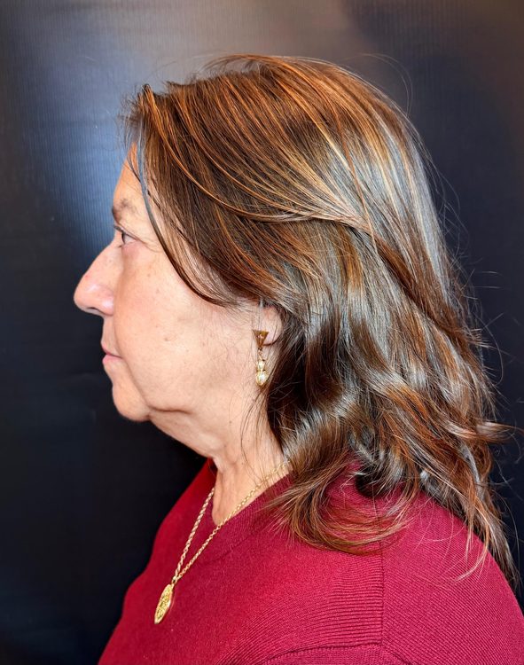 Antes — Rinomodelación