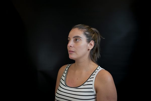 Antes — Rinomodelación y Labios