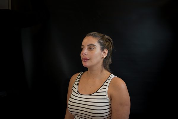 Después — Rinomodelación y Labios