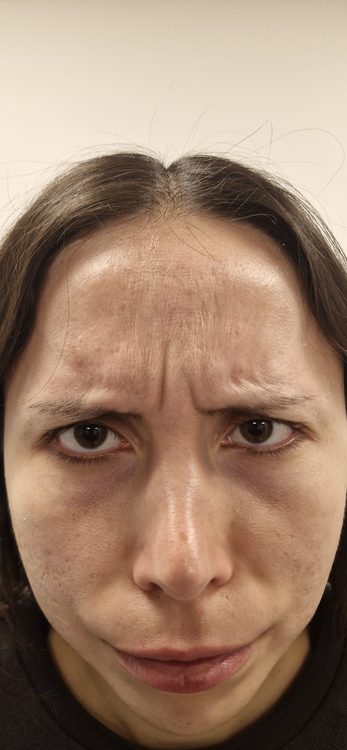 Antes — Toxina Botulínica