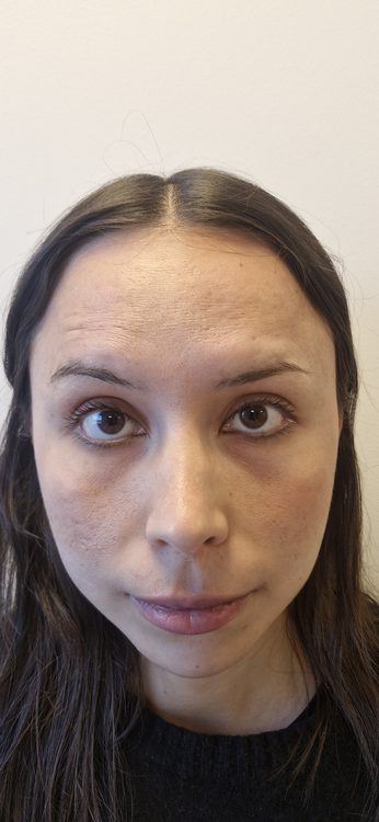 Después — Toxina Botulínica