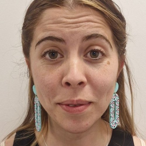 Antes — Toxina Botulínica